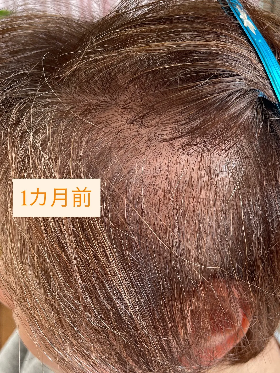 発毛ヘッドスパをされにこられました♪ホームケアがとても大切な...